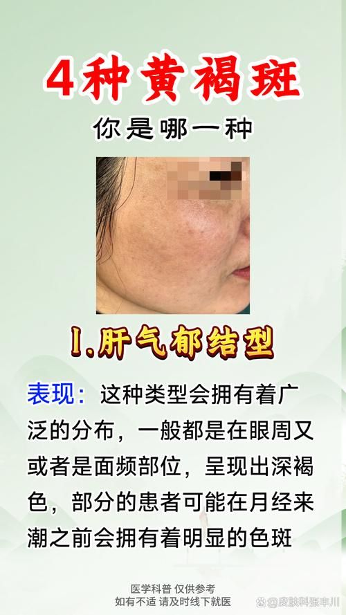 【河北邯郸邯山区最新疫情关注,脸上长黄褐斑看什么科】